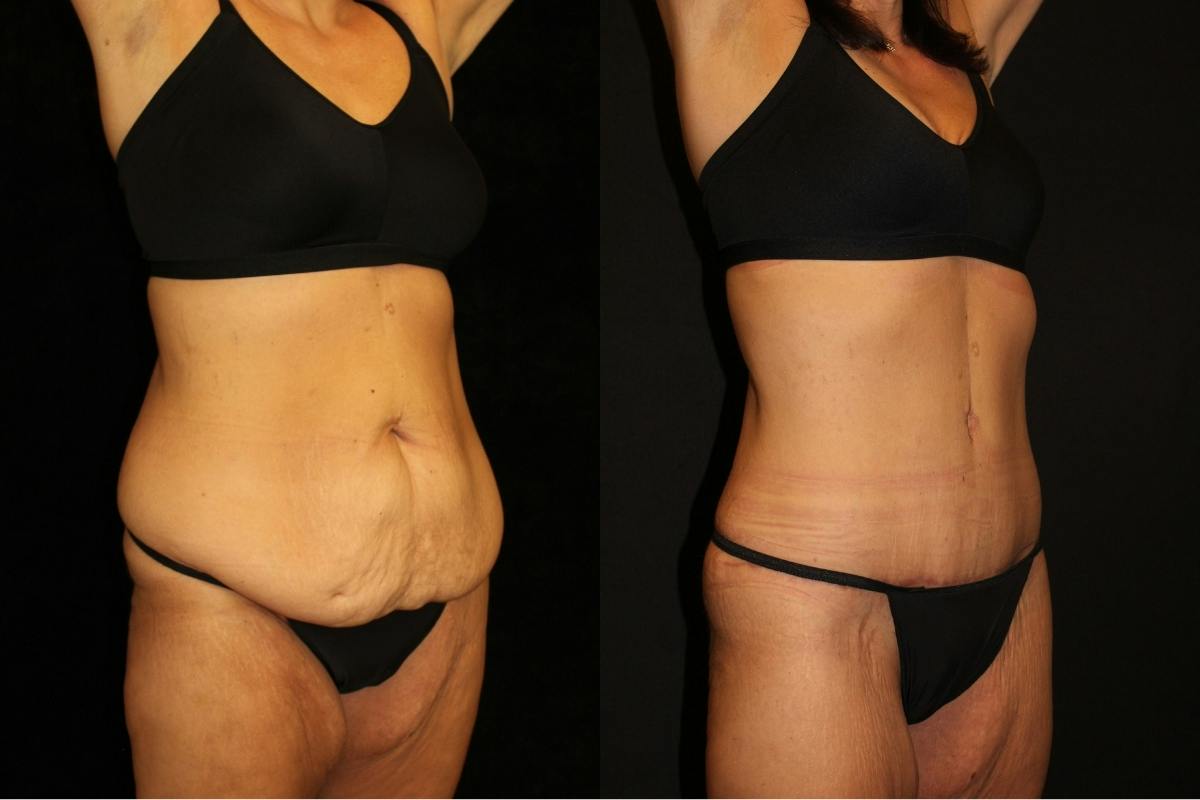 Mommy Makeover Before & After Gallery - Patient 411530 - Image 2