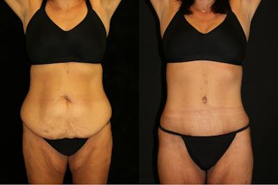 Mommy Makeover Before & After Gallery - Patient 411530 - Image 1