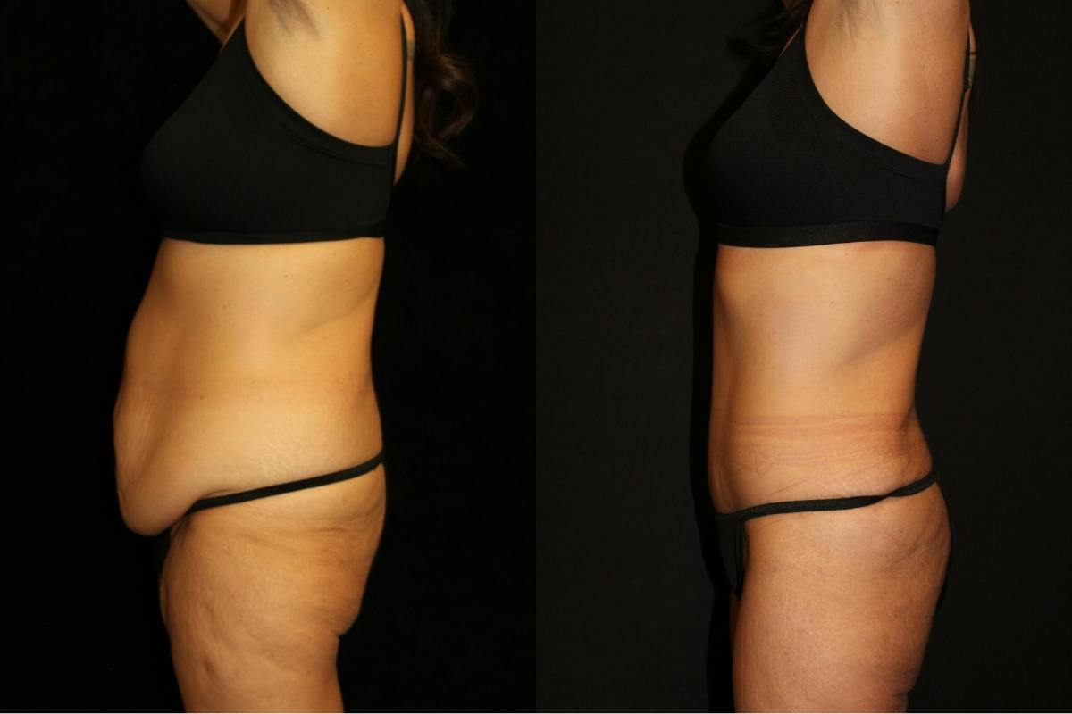 Mommy Makeover Before & After Gallery - Patient 411530 - Image 3
