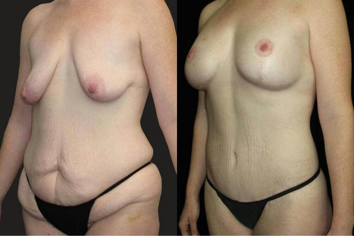 Mommy Makeover Before & After Gallery - Patient 502436 - Image 2