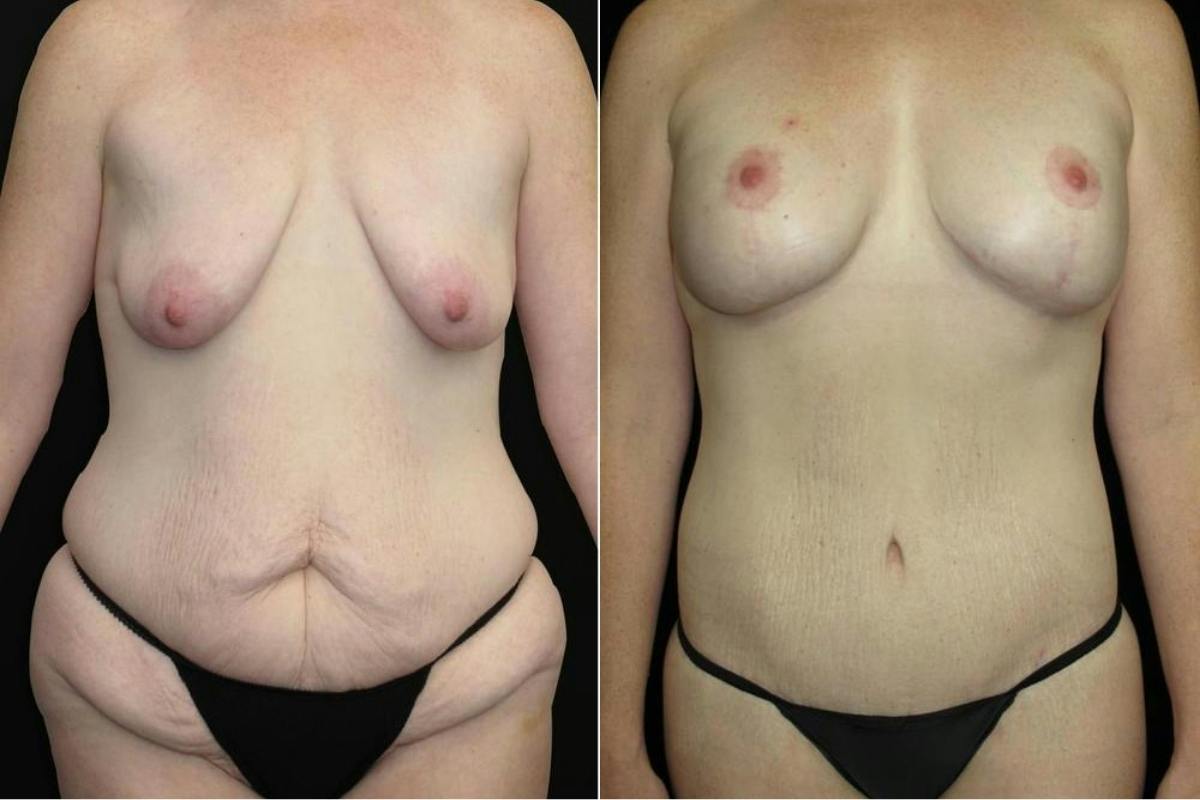Mommy Makeover Before & After Gallery - Patient 502436 - Image 1