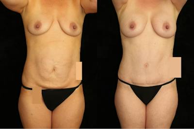 Mommy Makeover Before & After Gallery - Patient 442444 - Image 1