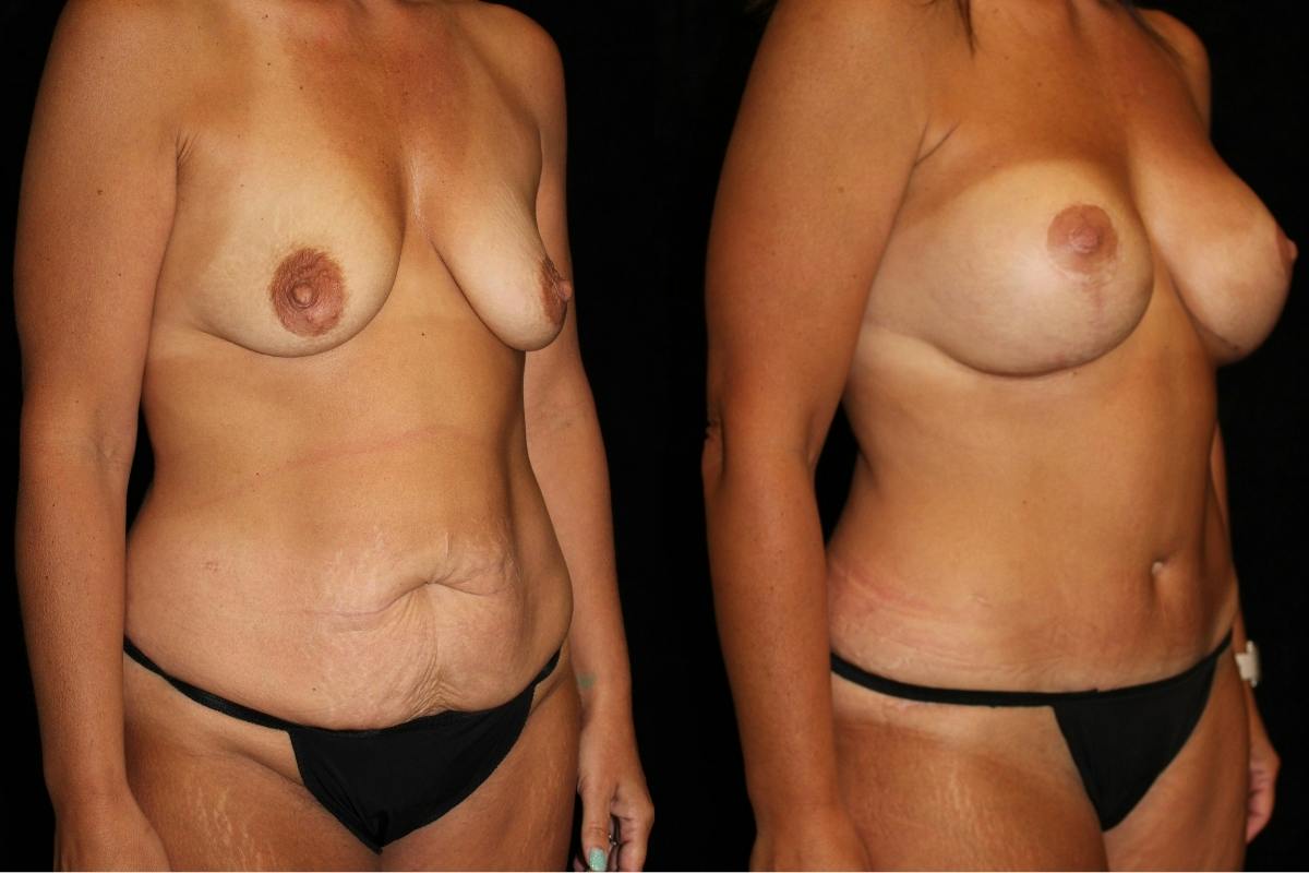 Mommy Makeover Before & After Gallery - Patient 271993 - Image 2