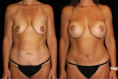Mommy Makeover Before & After Gallery - Patient 271993 - Image 1