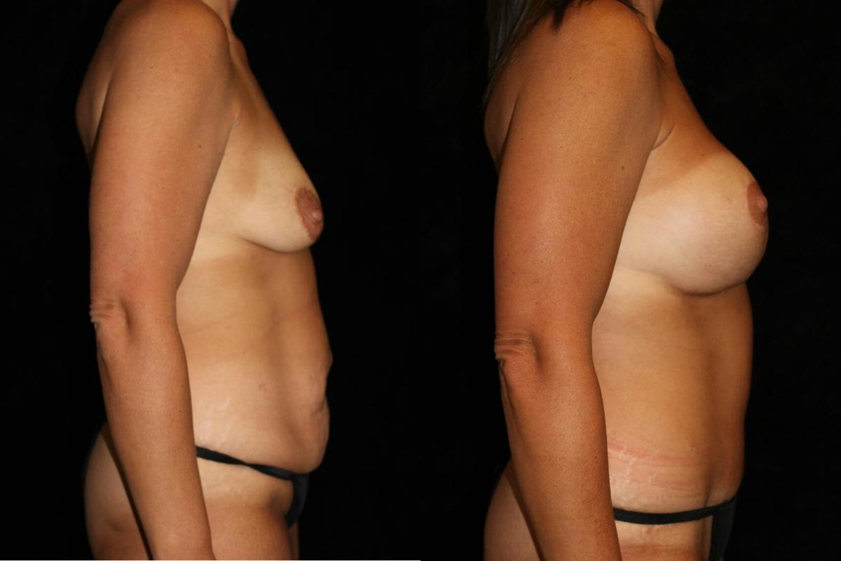 Mommy Makeover Before & After Gallery - Patient 271993 - Image 3