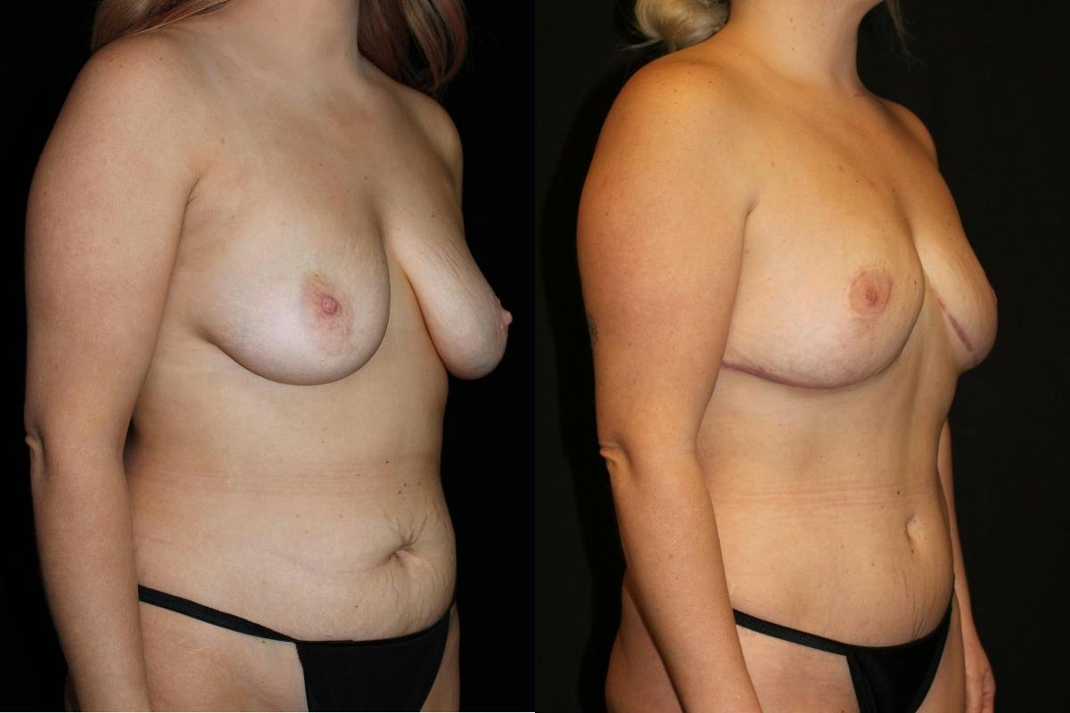 Mommy Makeover Before & After Gallery - Patient 514407 - Image 2