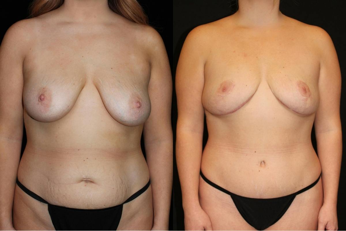 Mommy Makeover Before & After Gallery - Patient 514407 - Image 1