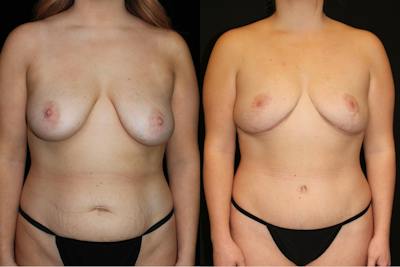 Mommy Makeover Before & After Gallery - Patient 514407 - Image 1