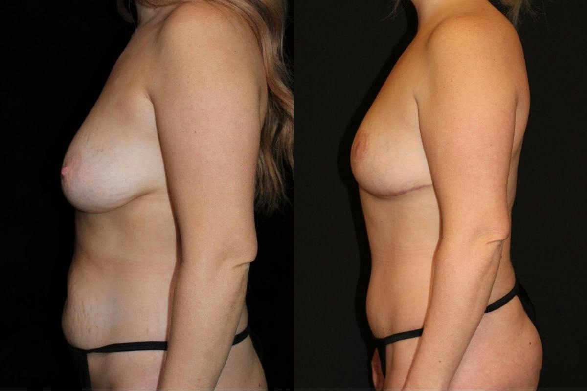 Mommy Makeover Before & After Gallery - Patient 514407 - Image 3