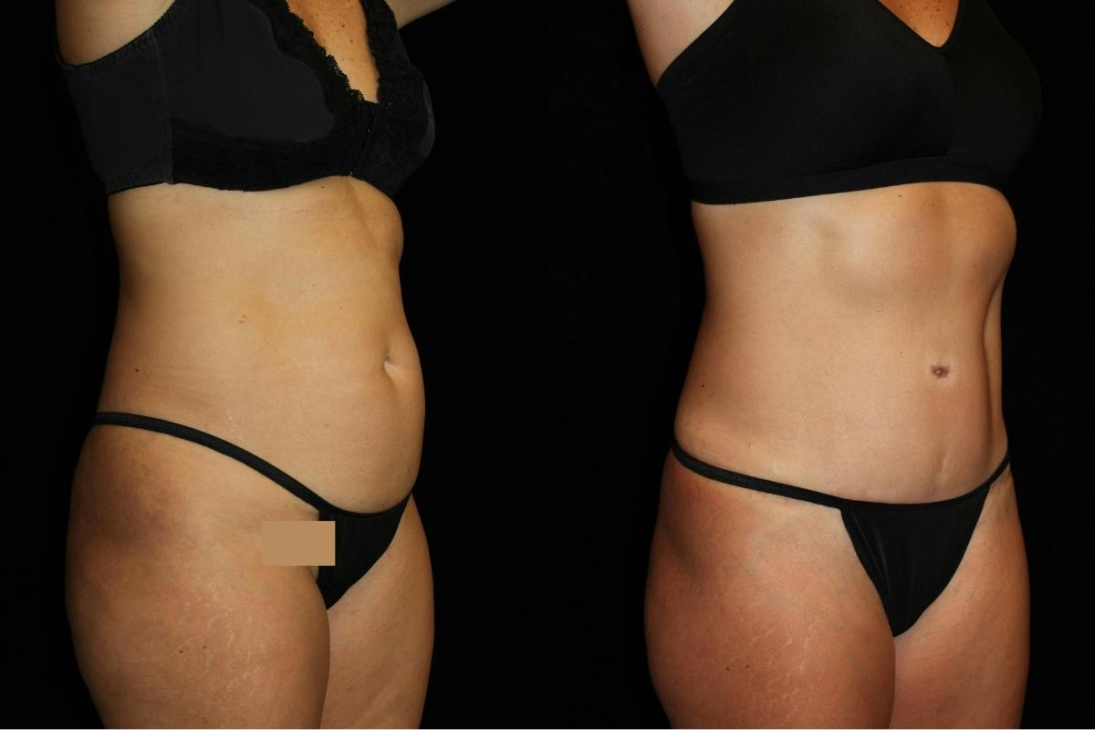 Mommy Makeover Before & After Gallery - Patient 248751 - Image 2