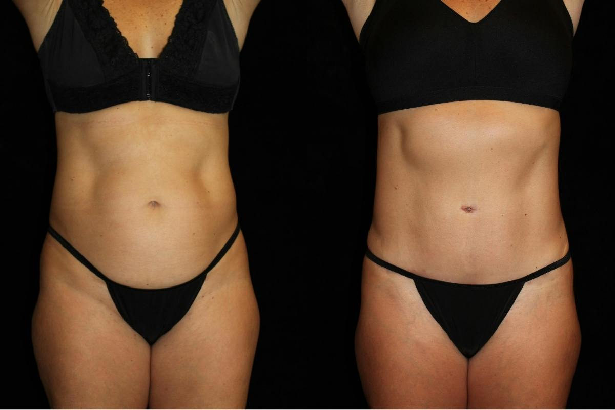 Mommy Makeover Before & After Gallery - Patient 248751 - Image 1