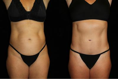 Mommy Makeover Before & After Gallery - Patient 248751 - Image 1
