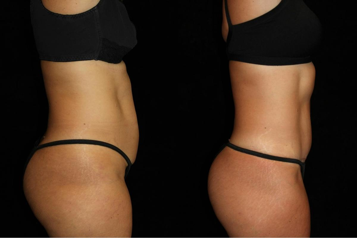Mommy Makeover Before & After Gallery - Patient 248751 - Image 3