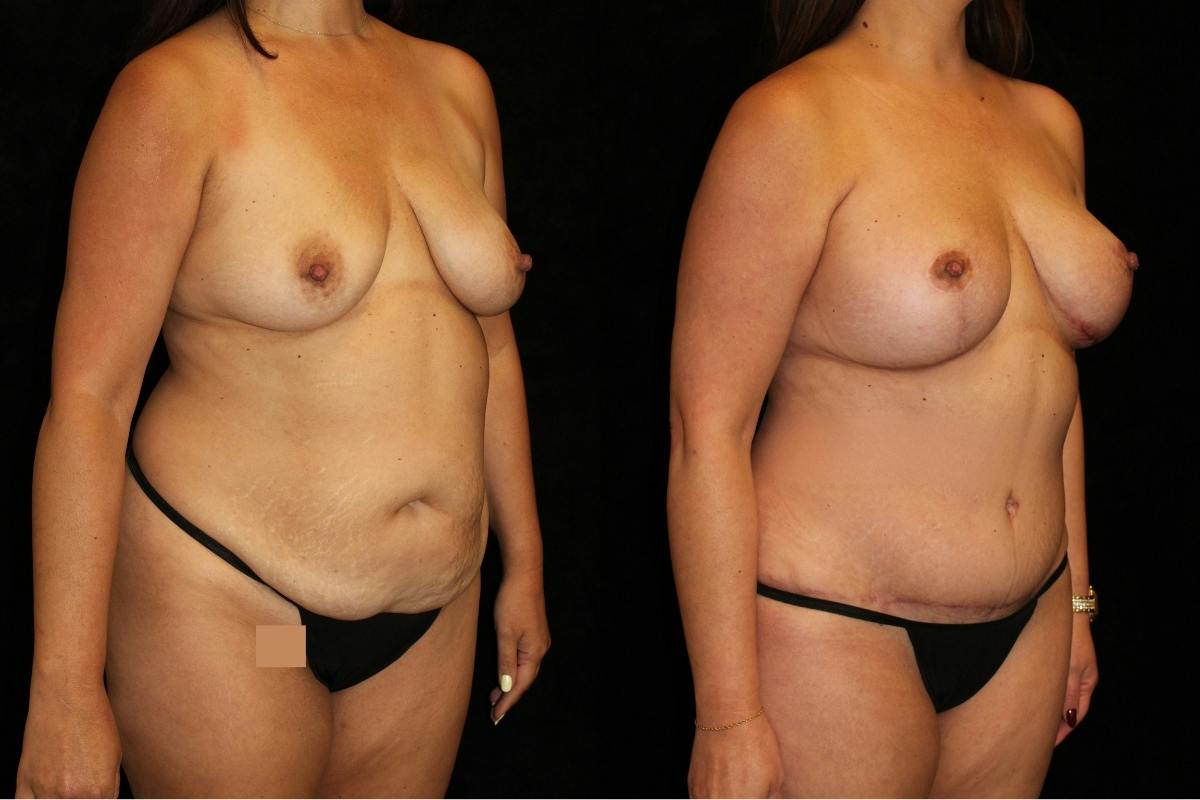 Mommy Makeover Before & After Gallery - Patient 484249 - Image 2