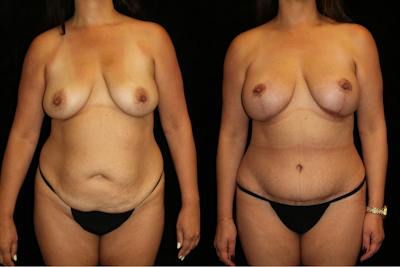 Mommy Makeover Before & After Gallery - Patient 484249 - Image 1