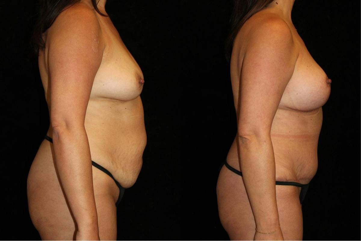 Mommy Makeover Before & After Gallery - Patient 484249 - Image 3