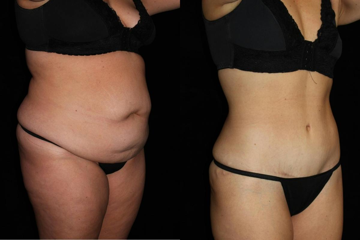 Mommy Makeover Before & After Gallery - Patient 296747 - Image 2
