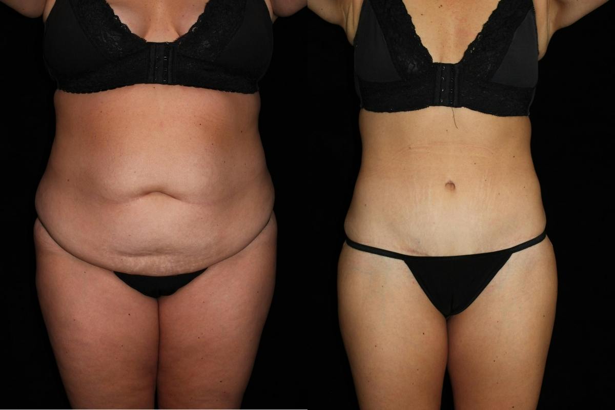 Mommy Makeover Before & After Gallery - Patient 296747 - Image 1