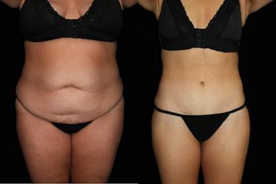 Mommy Makeover Before & After Gallery - Patient 296747 - Image 1