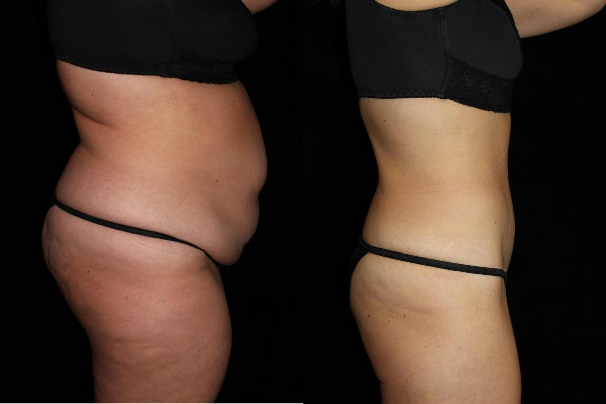 Mommy Makeover Before & After Gallery - Patient 296747 - Image 3