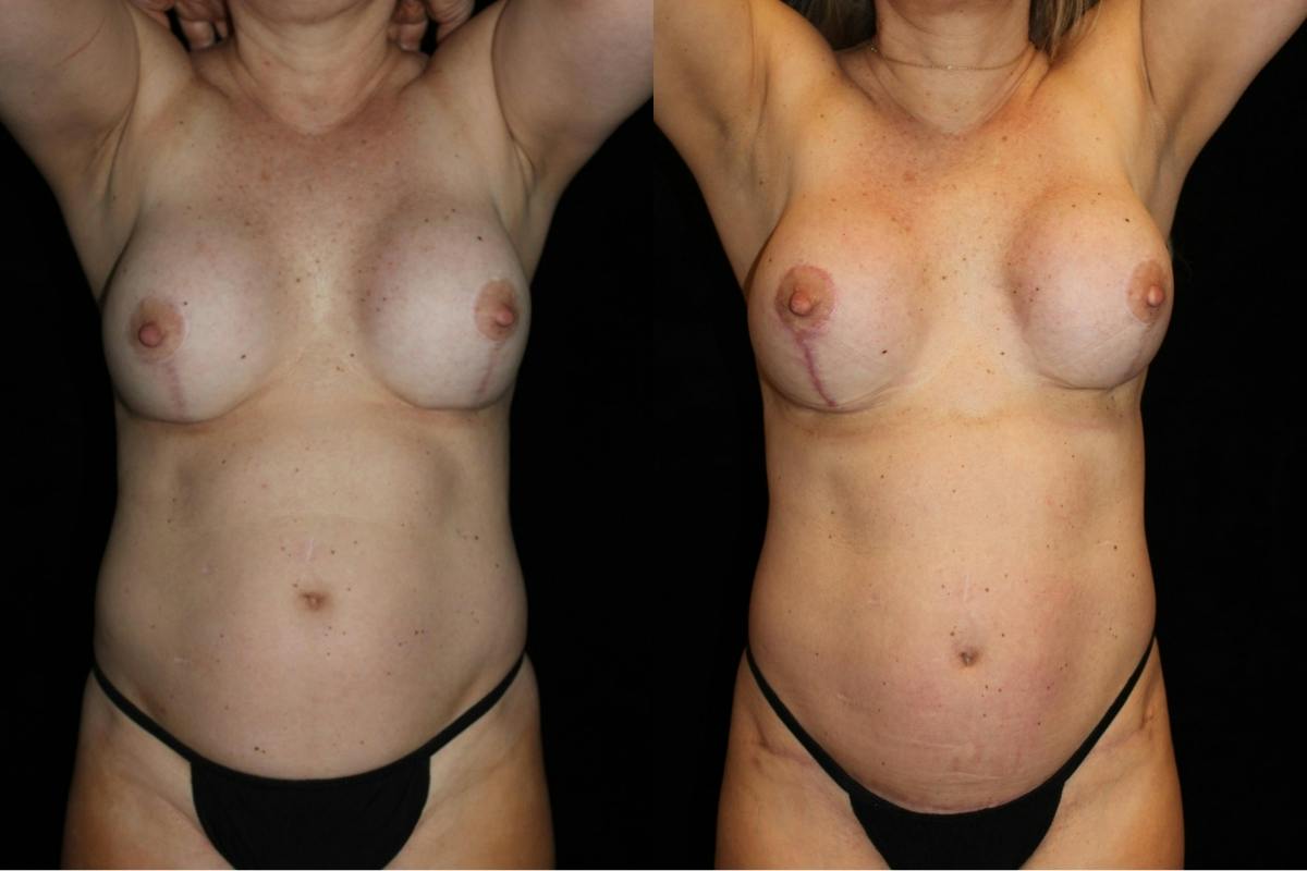 Mommy Makeover Before & After Gallery - Patient 216307 - Image 1