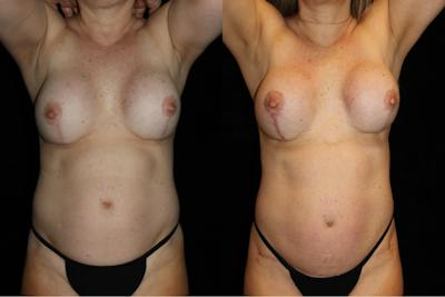 Mommy Makeover Before & After Gallery - Patient 216307 - Image 1