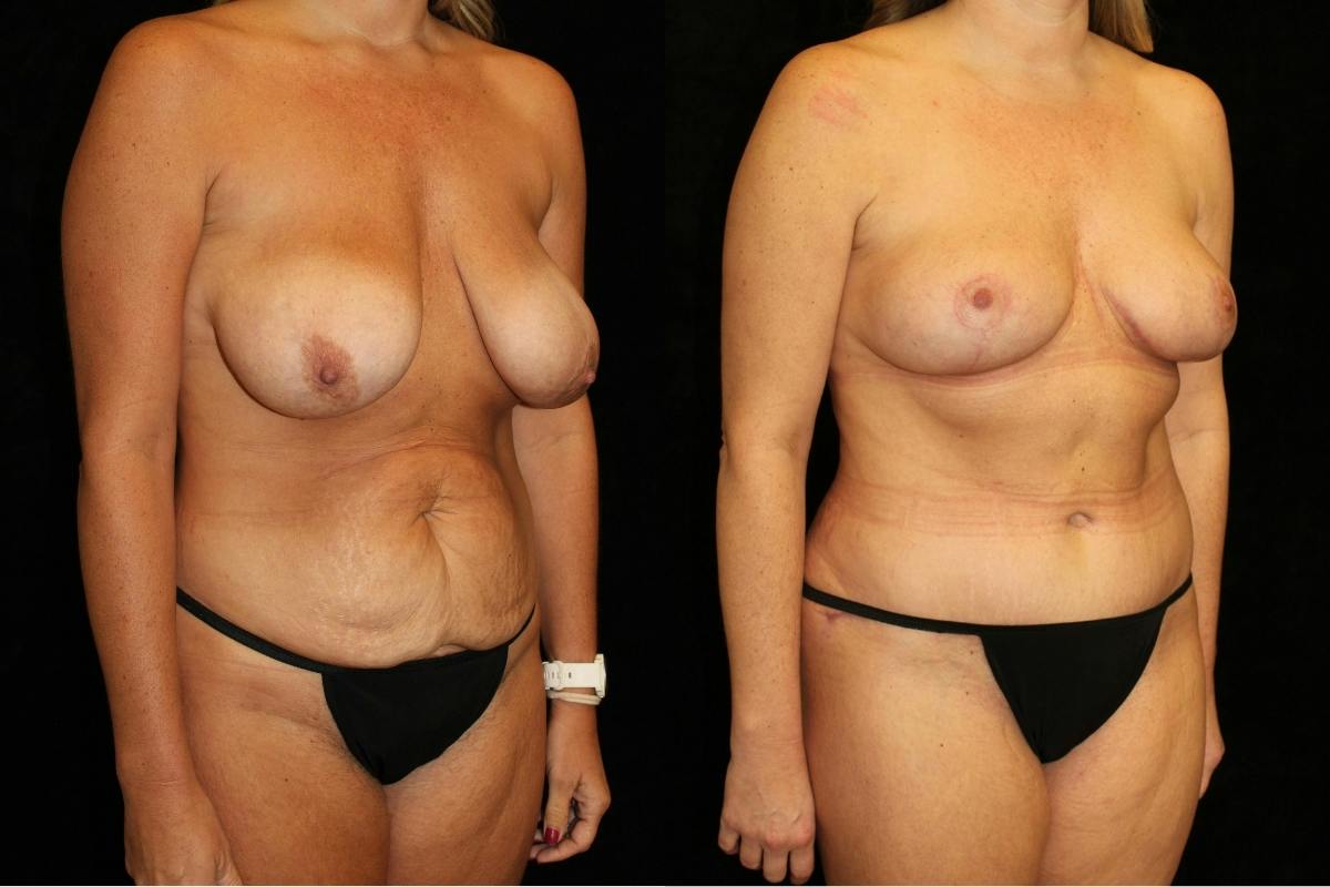 Mommy Makeover Before & After Gallery - Patient 189045 - Image 2