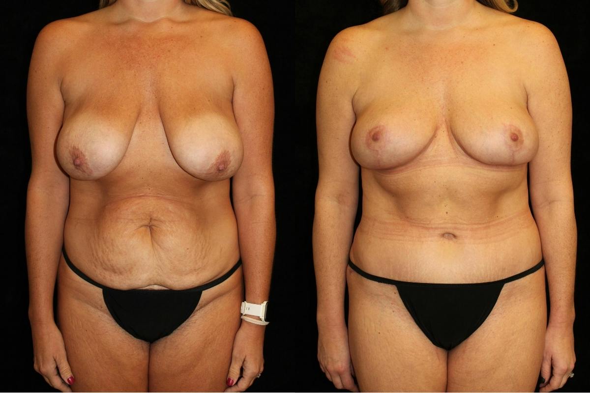 Mommy Makeover Before & After Gallery - Patient 189045 - Image 1