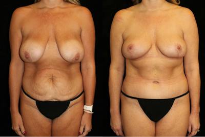 Mommy Makeover Before & After Gallery - Patient 189045 - Image 1