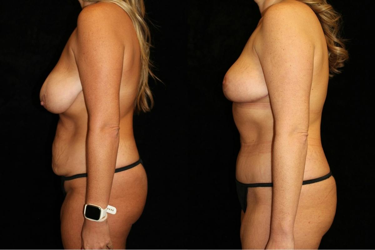 Mommy Makeover Before & After Gallery - Patient 189045 - Image 3