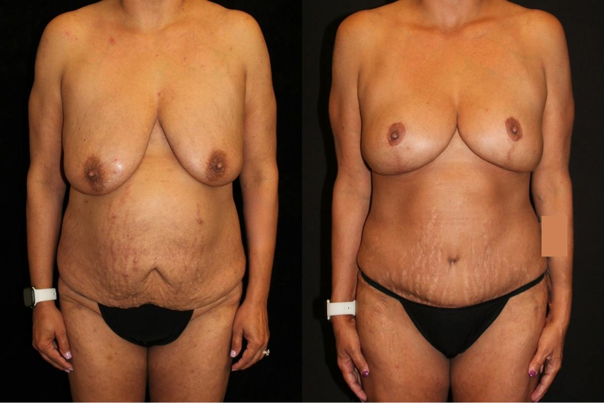 Mommy Makeover Before & After Gallery - Patient 294854 - Image 1