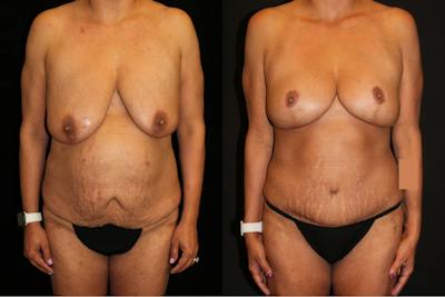 Mommy Makeover Before & After Gallery - Patient 294854 - Image 1
