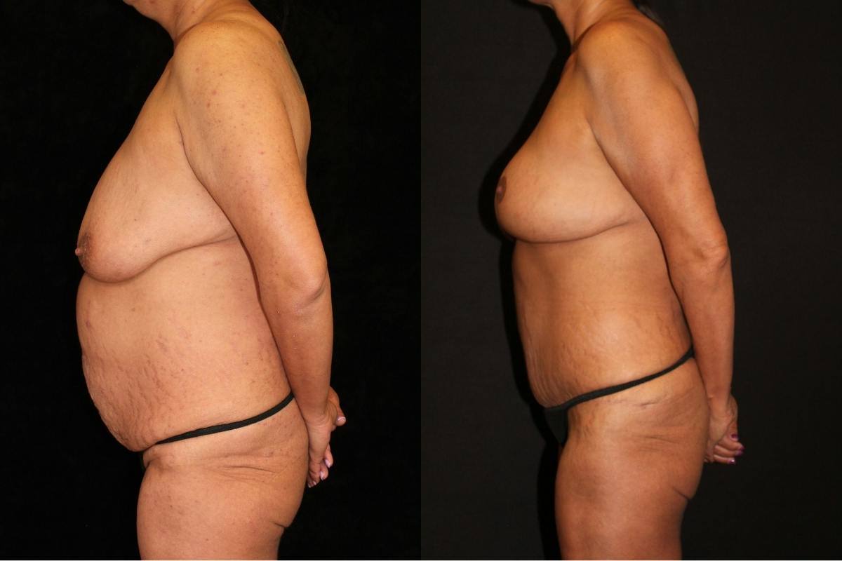 Mommy Makeover Before & After Gallery - Patient 294854 - Image 3