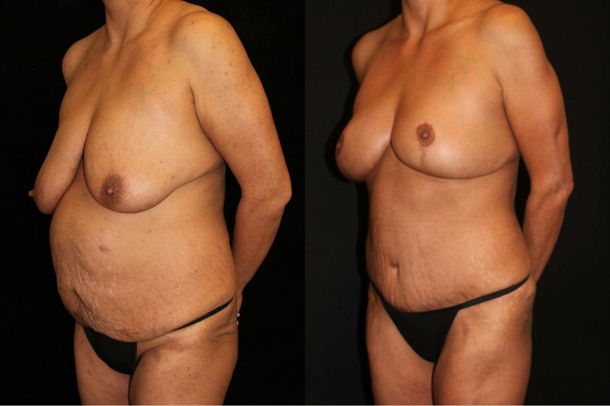 Mommy Makeover Before & After Gallery - Patient 294854 - Image 2