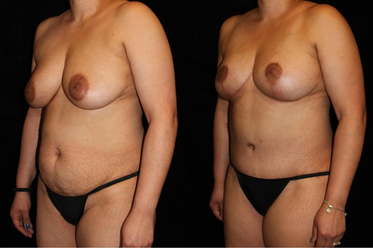 Mommy Makeover Before & After Gallery - Patient 305604 - Image 2