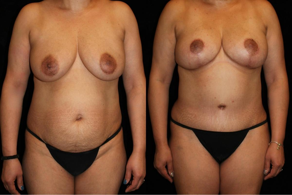 Mommy Makeover Before & After Gallery - Patient 305604 - Image 1