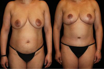 Mommy Makeover Before & After Gallery - Patient 305604 - Image 1