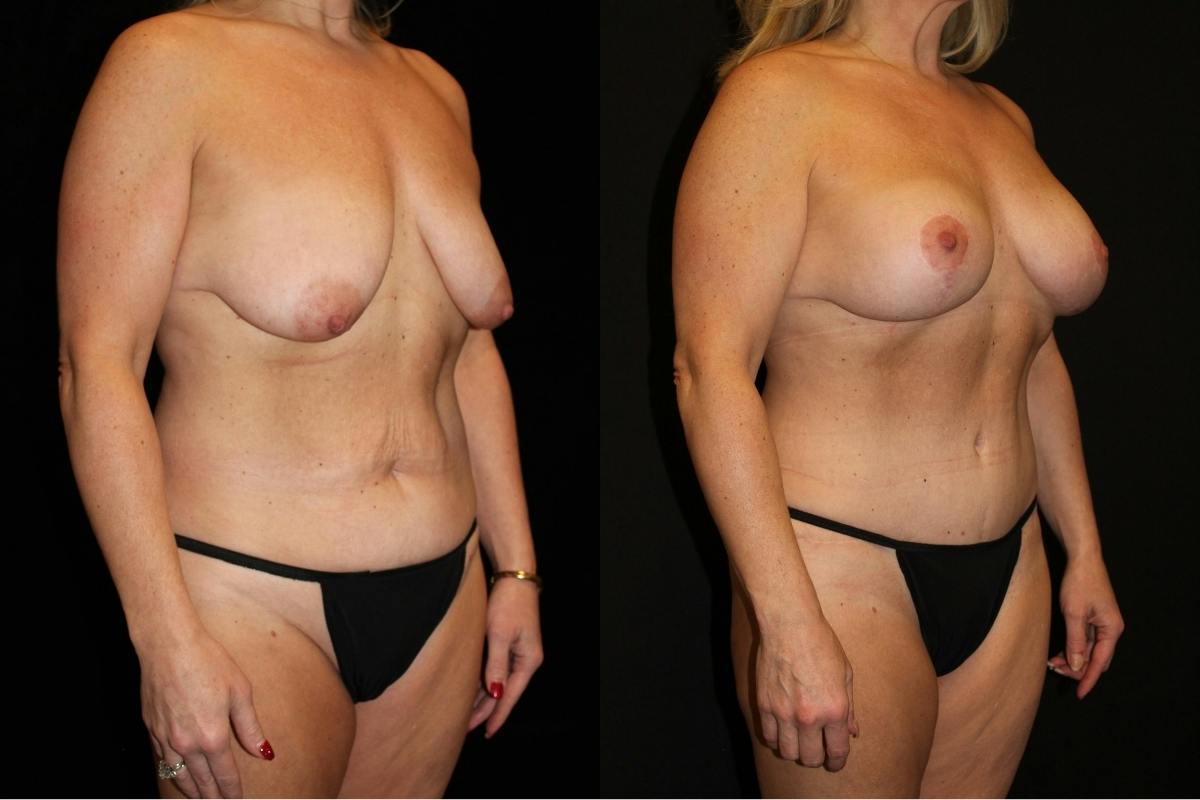 Mommy Makeover Before & After Gallery - Patient 140948 - Image 2