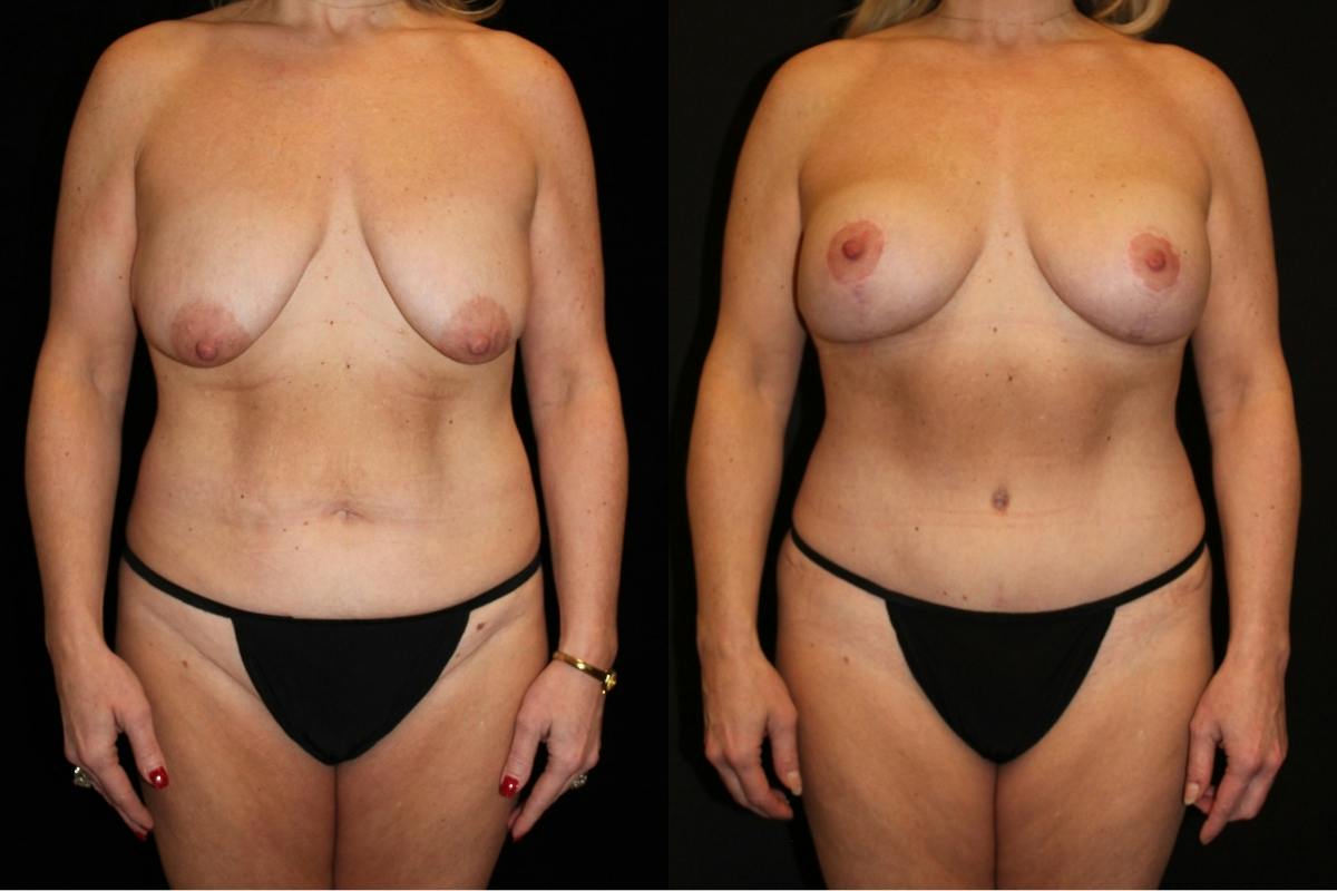 Mommy Makeover Before & After Gallery - Patient 140948 - Image 1