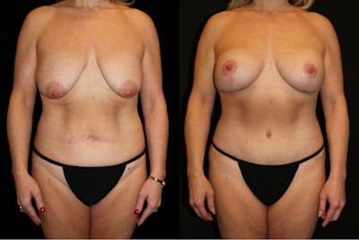 Mommy Makeover Before & After Gallery - Patient 140948 - Image 1