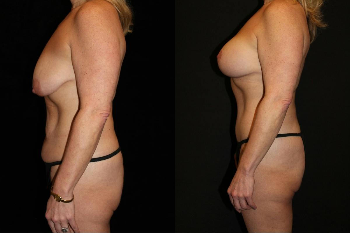 Mommy Makeover Before & After Gallery - Patient 140948 - Image 3