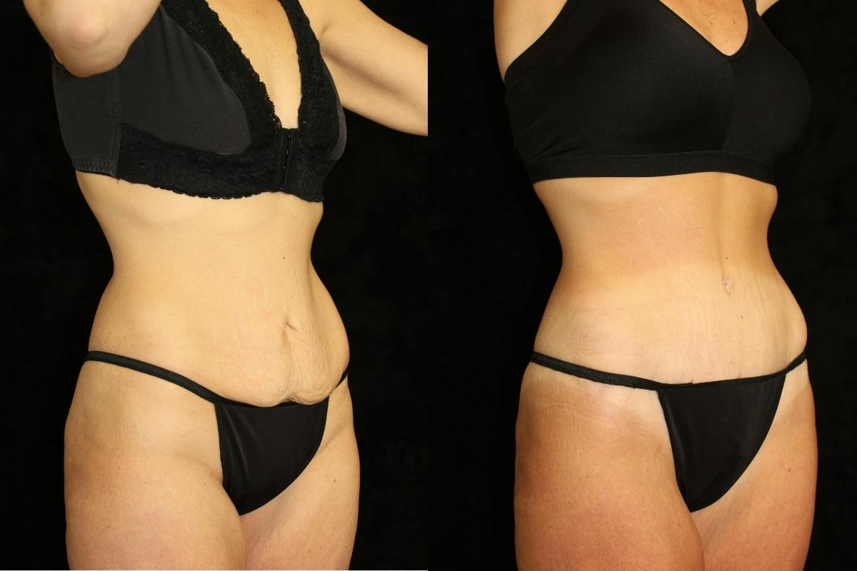 Tummy Tuck Before & After Gallery - Patient 350781 - Image 2