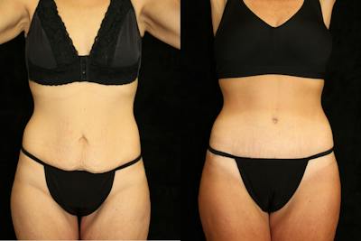 Tummy Tuck Before & After Gallery - Patient 350781 - Image 1