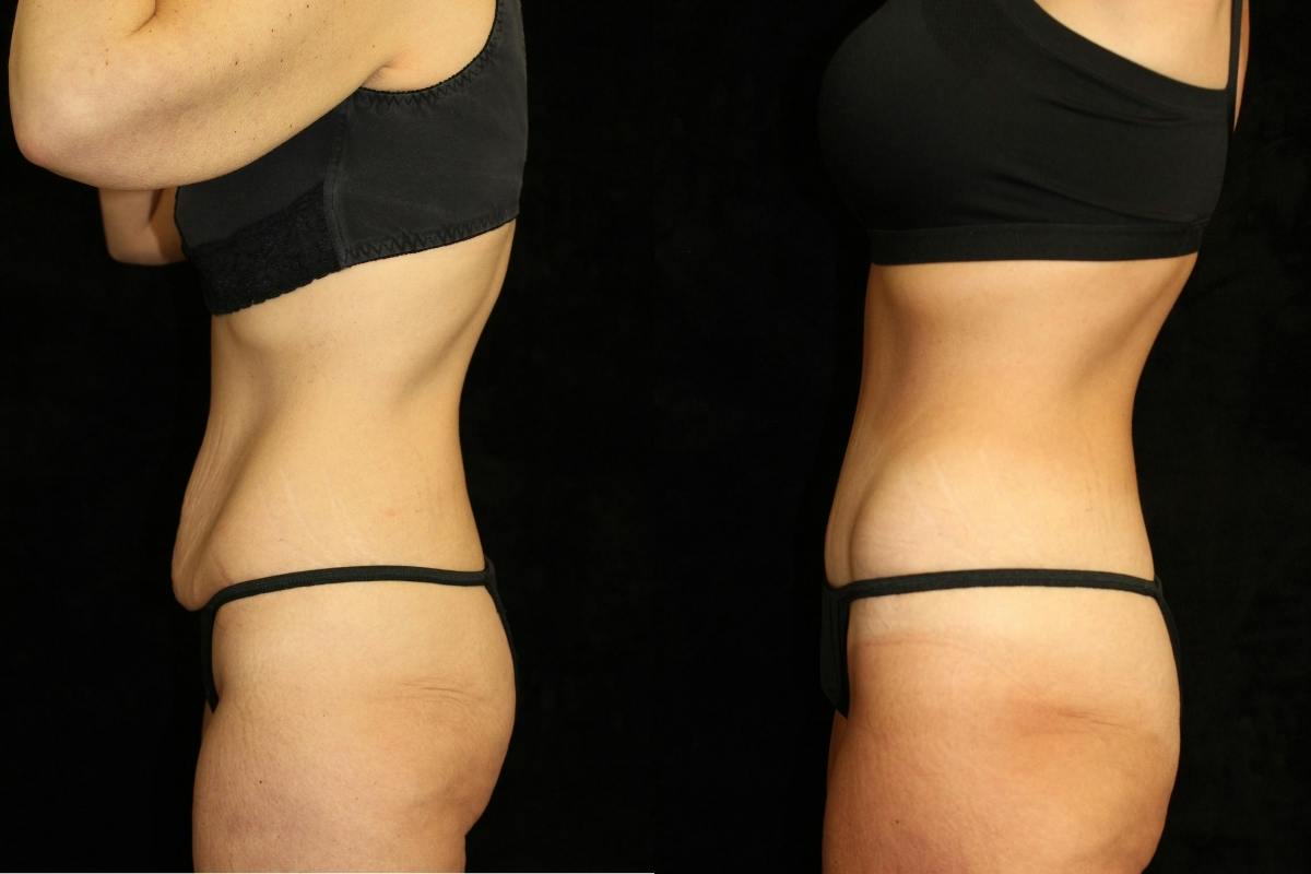 Tummy Tuck Before & After Gallery - Patient 350781 - Image 3