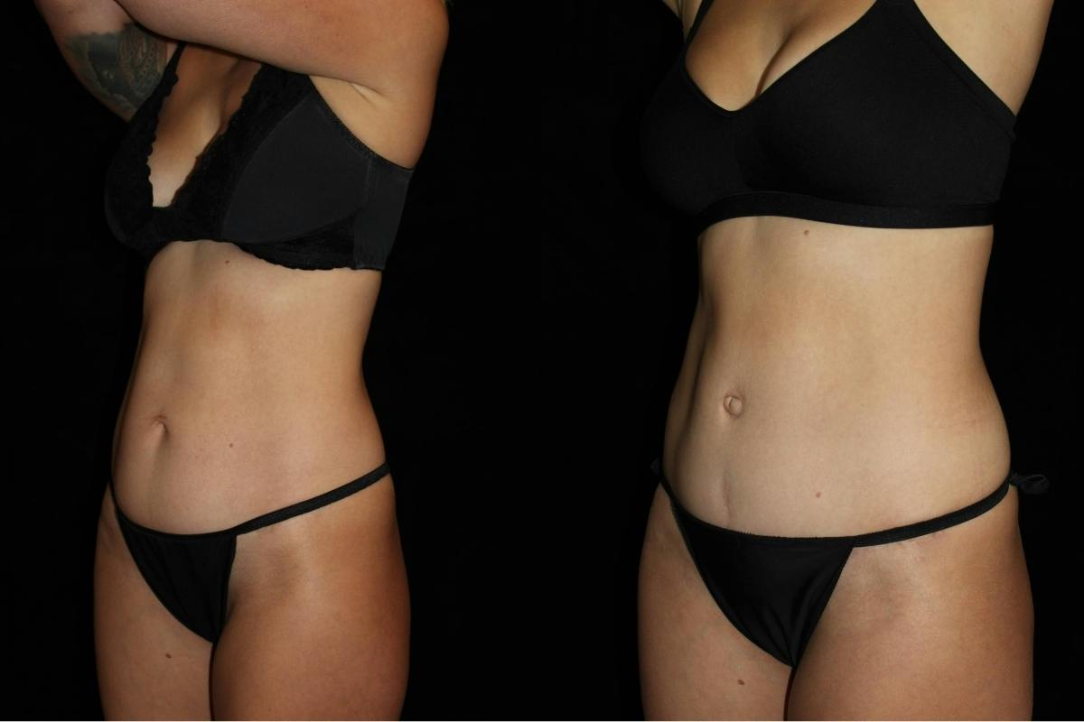 Tummy Tuck Before & After Gallery - Patient 346456 - Image 2