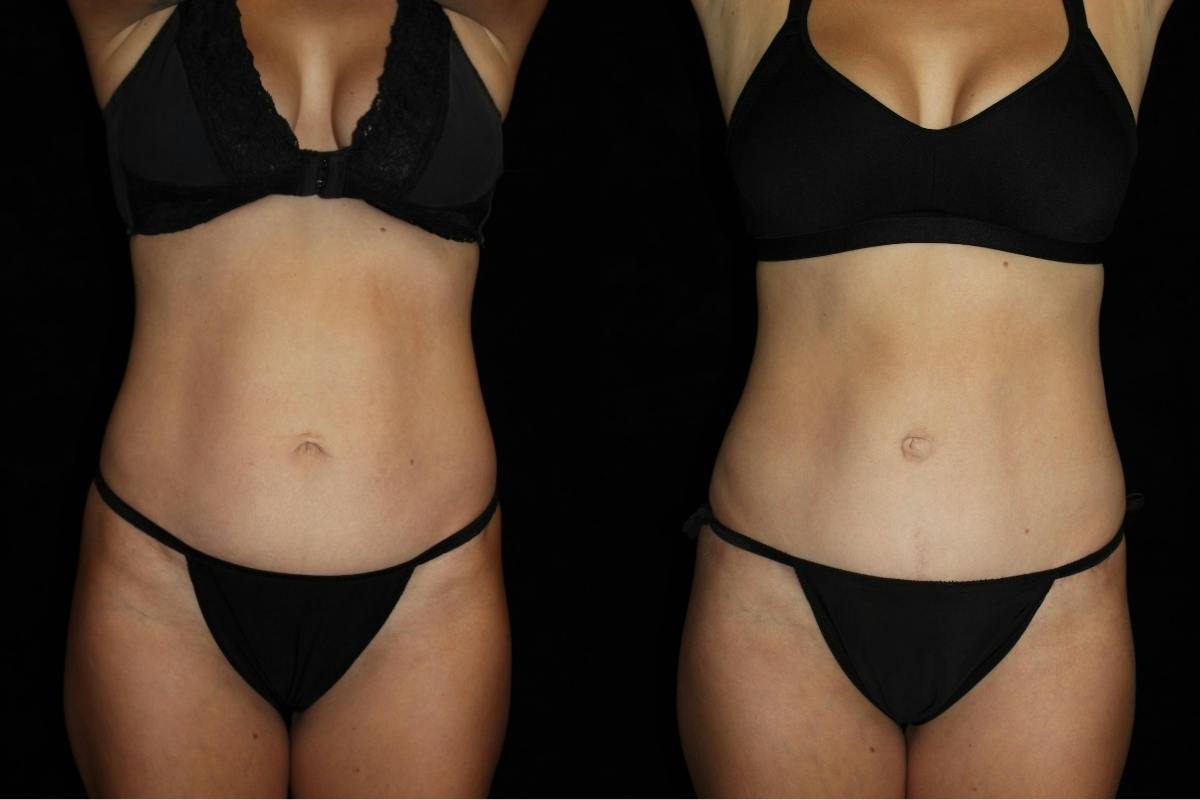 Tummy Tuck Before & After Gallery - Patient 346456 - Image 1