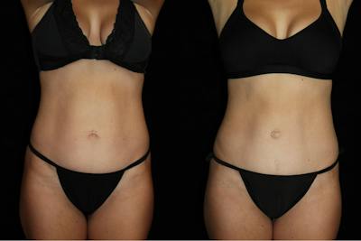 Tummy Tuck Before & After Gallery - Patient 346456 - Image 1