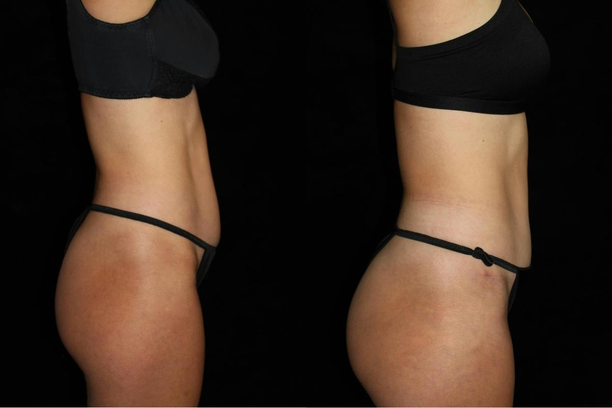 Tummy Tuck Before & After Gallery - Patient 346456 - Image 3