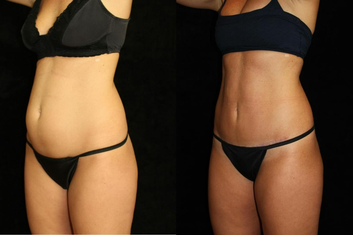 Tummy Tuck Before & After Gallery - Patient 288840 - Image 2