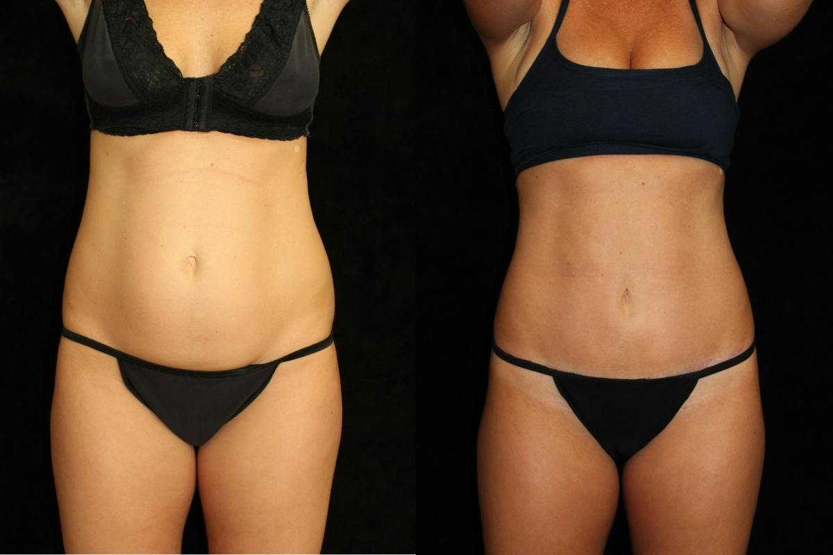 Tummy Tuck Before & After Gallery - Patient 288840 - Image 1
